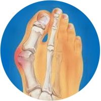 Drawing of hallux valgus with a prominent inflamed bunion in blue font