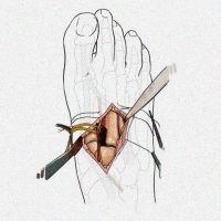 Diagram of intraoperative picture of a right foot with a midfoot dislocation