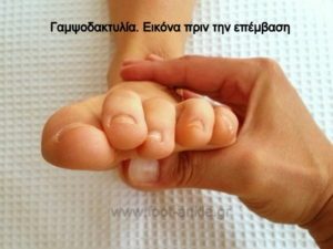 Clinical picture of a left foot with a claw toe deformity of the lesser toes, as seen from the front